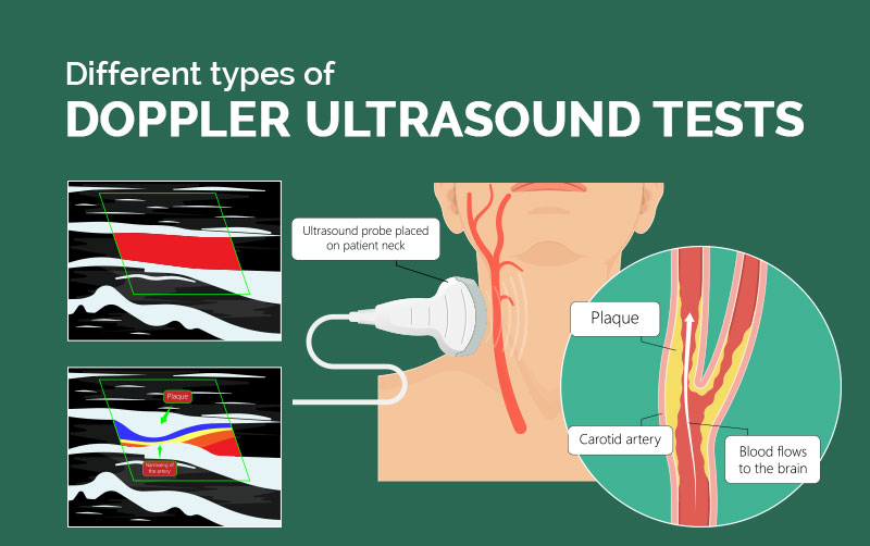 Doppler sonography